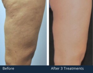 Before and After Image of Cellulite Treatment