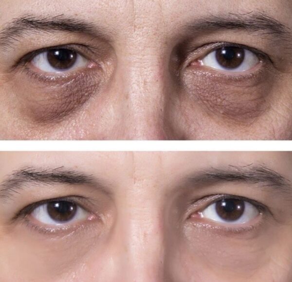 1 Effective PRP Under Eyes Treatment For Hollows, Eye Bags, Dark Circles