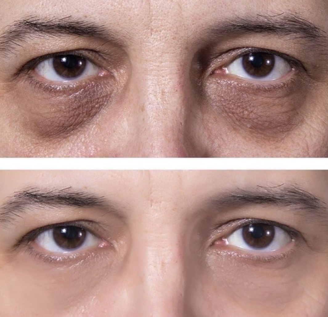 dark bags under eyes treatment
