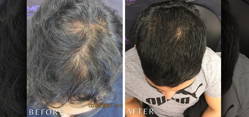 PRP Hair Treatments – What is it & Why You Should Consider It?