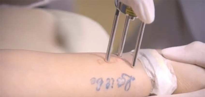 Everything to Know About Laser Tattoo Removal