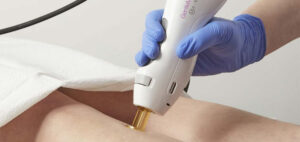 How Does Gentlemax Pro Plus Laser Vein Treatment Work