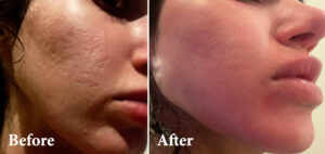Treating Acne Scars SecretPro RFM & CO2 Laser Therapy