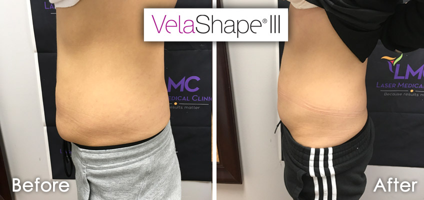 Candela’s Velashape III for Toning & Tightening the Stomach