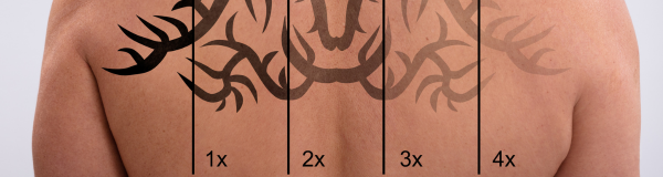 PicoSure Tattoo Removal  Laser tattoo Tattoo removal Picosure tattoo  removal