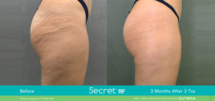 Treating Stretch Marks With Rf Microneedling