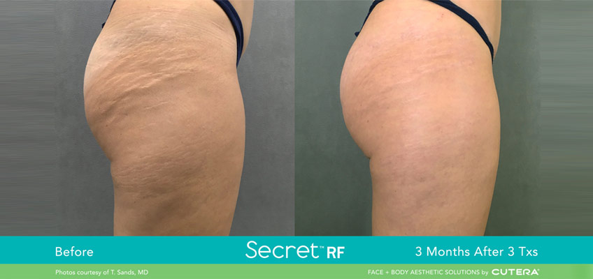 How Does Microneedling Minimize Stretch Marks?