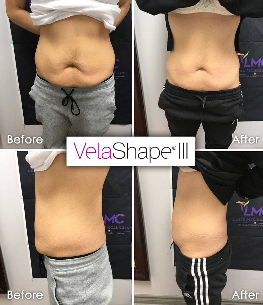 What Is Velashape Iii How Does Works Before After