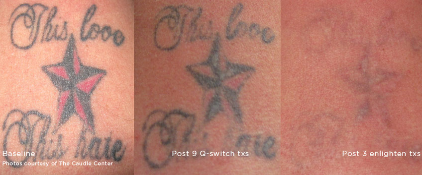 How Effective Is Cutera Enlighten Tattoo Removal