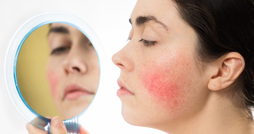 What is Rosacea?