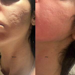 Acne Scar Removal Cutera Secret Pro Before After