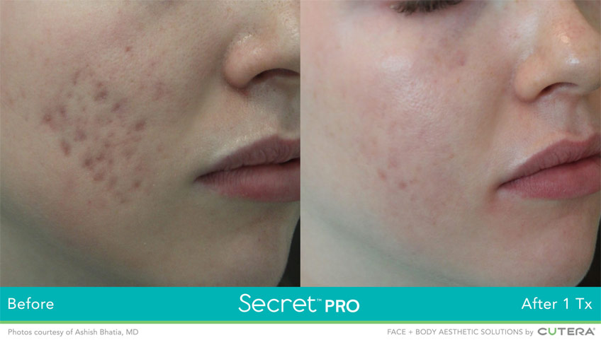 Acne Scarring: 4 Frequently Asked Questions