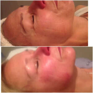 Dermalux Flex Md Phototherapy Before After Photo 10