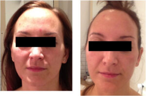 Dermalux Flex Md Phototherapy Before After Photo 11