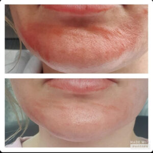 Dermalux Flex Md Phototherapy Before After Photo 12
