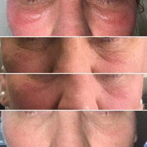 Dermalux Flex Md Phototherapy Before After Photo 2