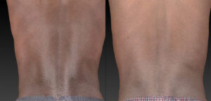 Dermalux Flex Md Phototherapy Before After Photo 3
