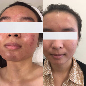 Dermalux Flex Md Phototherapy Before After Photo 5