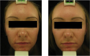 Dermalux Flex Md Phototherapy Before After Photo 6