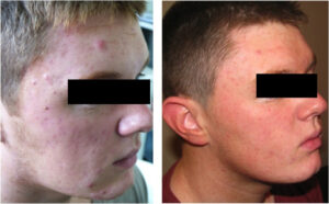 Dermalux Flex Md Phototherapy Before After Photo 7