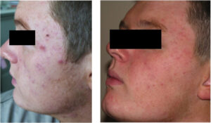 Dermalux Flex Md Phototherapy Before After Photo 8