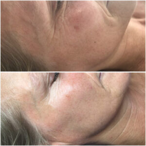 Dermalux Flex Md Phototherapy Before After Photo 9