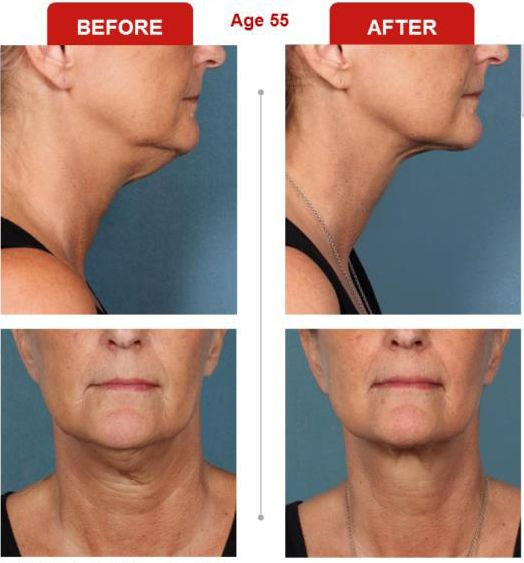 Double Chin Treatment Before After Photo 1