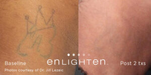 Enlighten Laser Tattoo Removal Before After 10