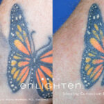 Enlighten Laser Tattoo Removal Before After 12