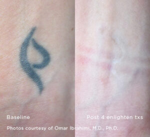 Enlighten Laser Tattoo Removal Before After 13