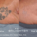 Enlighten Laser Tattoo Removal Before After 14