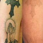 Enlighten Laser Tattoo Removal Before After 15