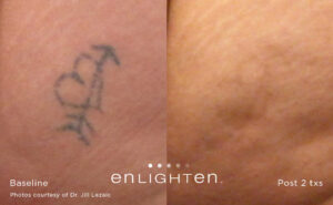 Enlighten Laser Tattoo Removal Before After 2