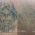 Enlighten Laser Tattoo Removal Before After 5