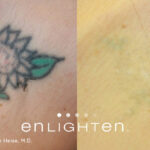 Enlighten Laser Tattoo Removal Before After 6