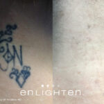 Enlighten Laser Tattoo Removal Before After 7