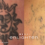Enlighten Laser Tattoo Removal Before After 8