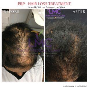 Female PRP Hair Restoration Treatment Before And After