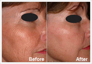 Fractional Non Ablative Skin Resurfacing Treatment Before After