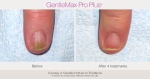 Gentle Max Pro Plus Nail Fungus Treatment - Onychomycosis