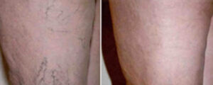 Laser Vein Removal Before After Photo 1