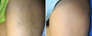 Laser Vein Removal Before After Photo 2