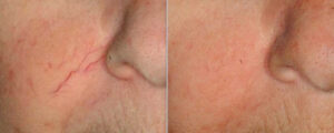 Laser Vein Removal Before After Photo 3