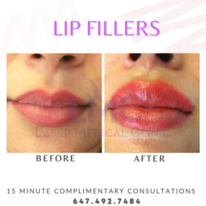 Lip Fillers Before After Photo 1