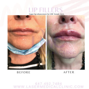 Lip Fillers Before After Photo Upper Lip Enhancement