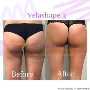 Lmc Velaspape 3 Cellulite Reduction Before After Photo