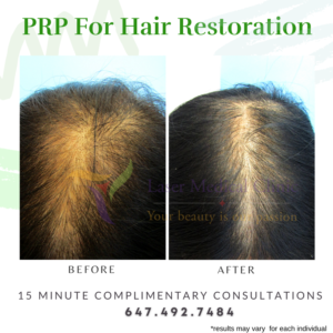 PRP Hair Restoration Female Before After