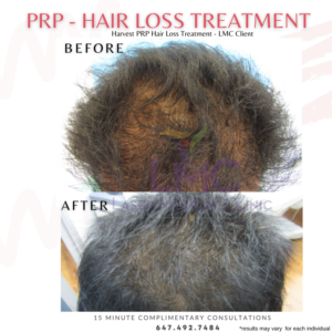 PRP Hair Restoration Male Before and After
