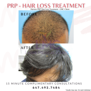 PRP Hair Restoration Male Hair Transplant Client Before After
