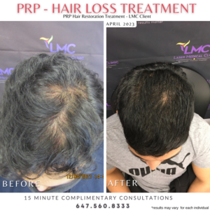 PRP Hair Loss Treatment Before And After 2023